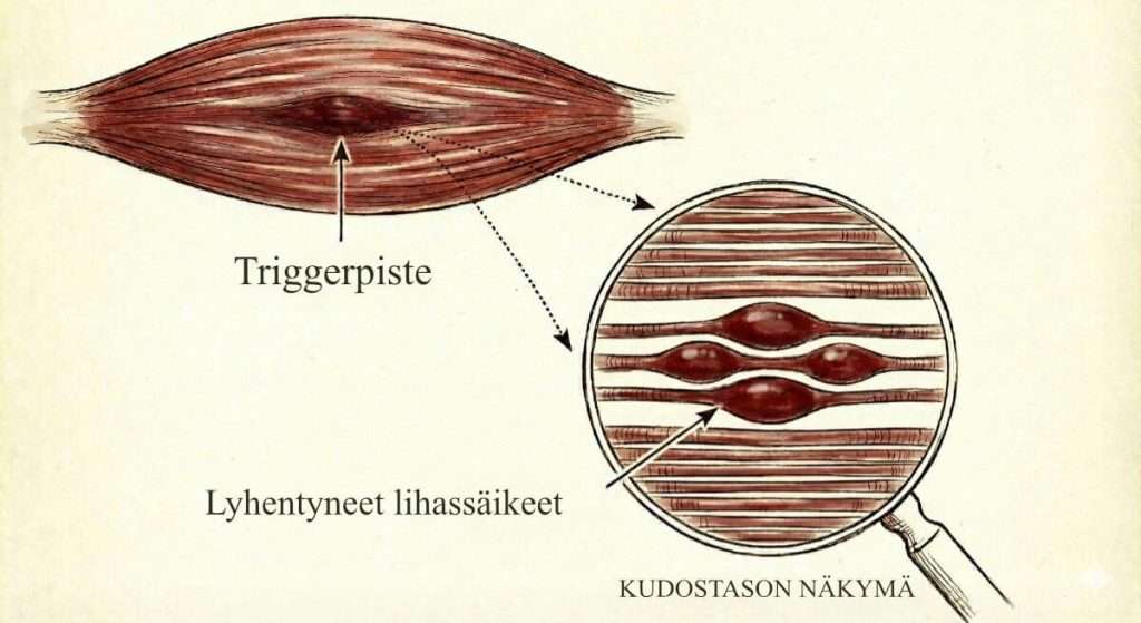 Havainnekuva lihasjumista, joka voi aiheuttaa esimerkiksi toispuoleista alaselkäkipua.